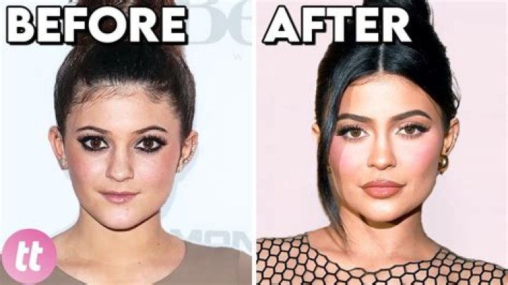 Before And After Plastic Surgery!