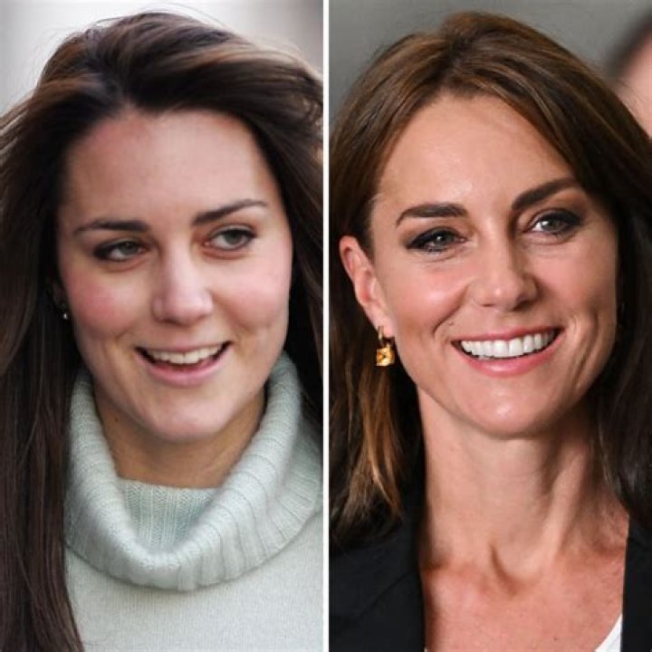 Kate Middleton Plastic Surgery: Frown Lines And Wrinkles Worse – Duchess Of Cambridge Not Aging Gracefully